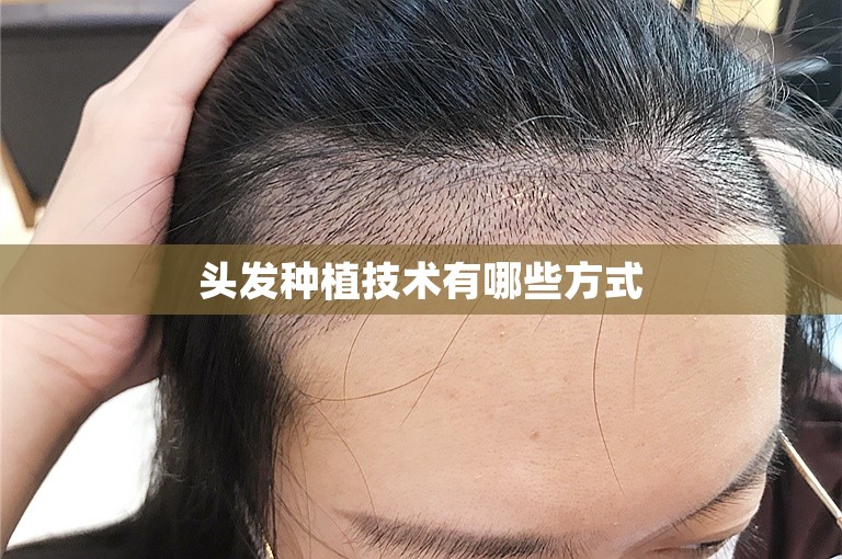 头发种植技术有哪些方式