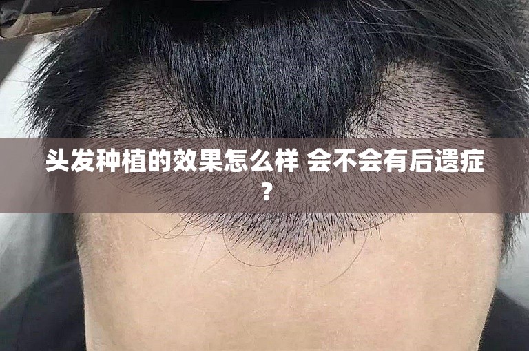 头发种植的效果怎么样 会不会有后遗症？