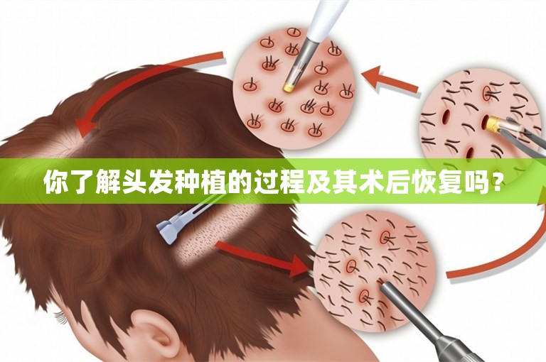 你了解头发种植的过程及其术后恢复吗？