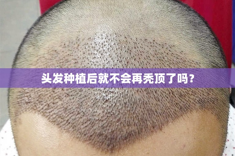 头发种植后就不会再秃顶了吗？