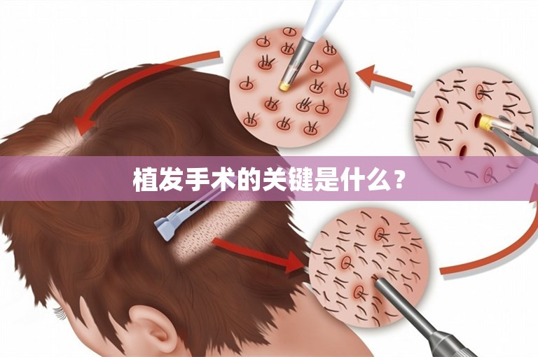 植发手术的关键是什么？