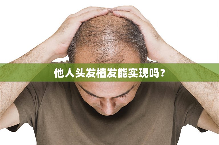 他人头发植发能实现吗？