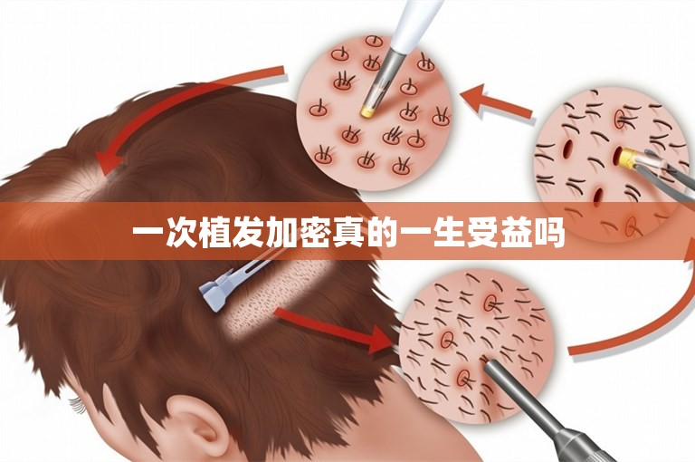 一次植发加密真的一生受益吗