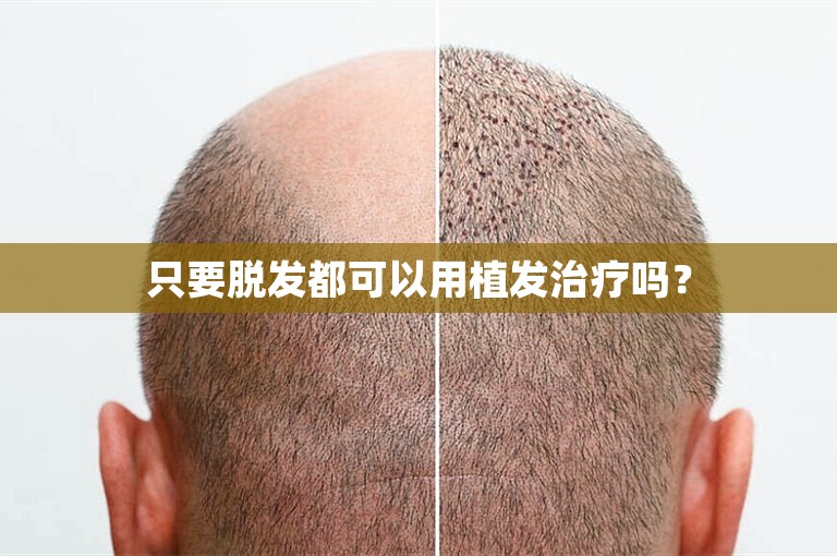 只要脱发都可以用植发治疗吗？