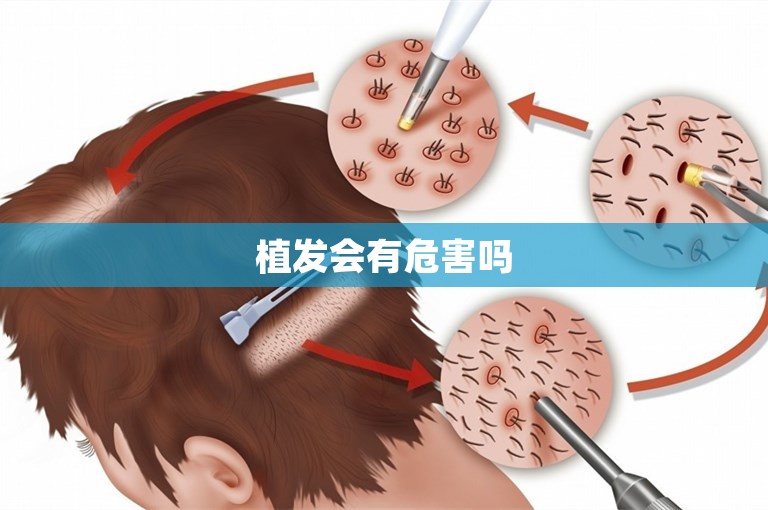 植发会有危害吗