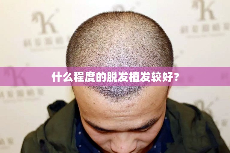 什么程度的脱发植发较好？