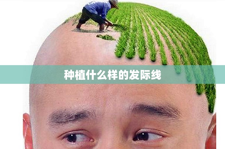 种植什么样的发际线