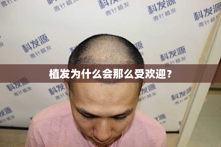 植发为什么会那么受欢迎？