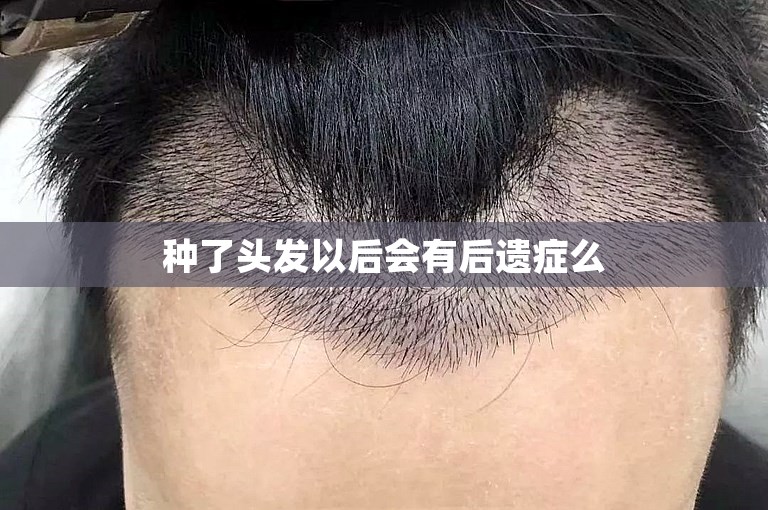 种了头发以后会有后遗症么