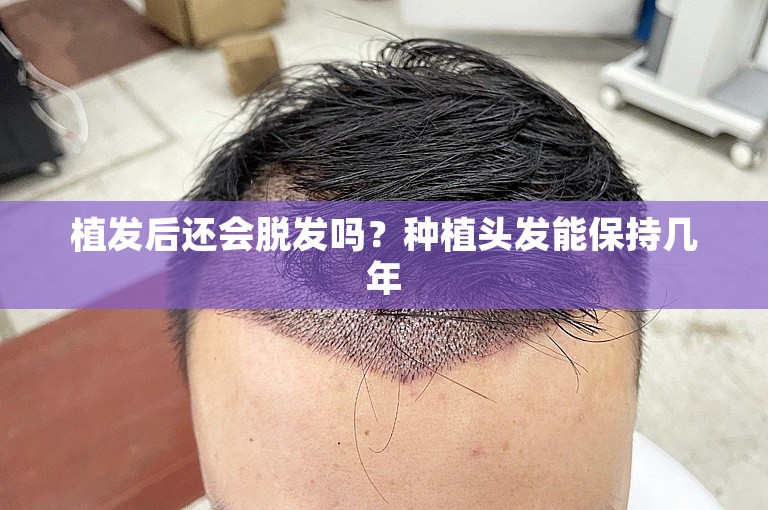 植发后还会脱发吗？种植头发能保持几年