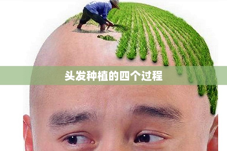 头发种植的四个过程