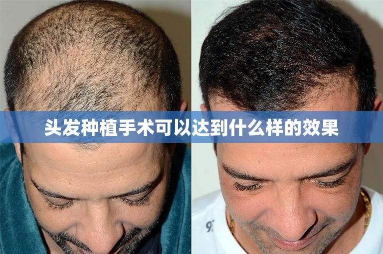 头发种植手术可以达到什么样的效果