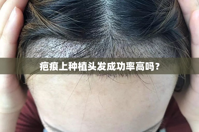 疤痕上种植头发成功率高吗？