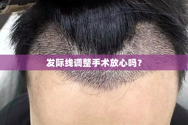 发际线调整手术放心吗？