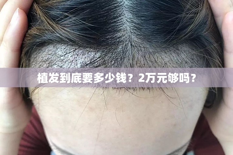 植发到底要多少钱？2万元够吗？