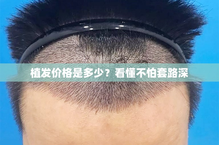 植发价格是多少？看懂不怕套路深