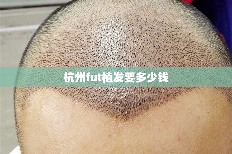 杭州fut植发要多少钱