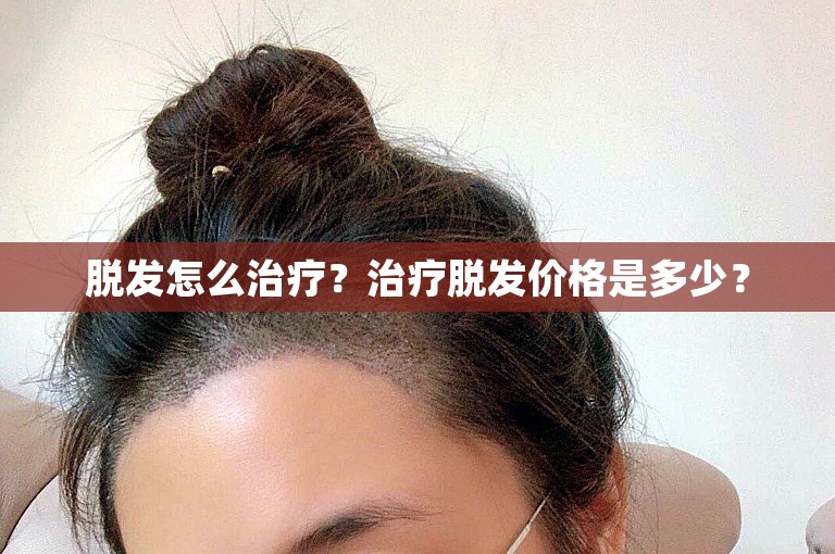 脱发怎么治疗？治疗脱发价格是多少？