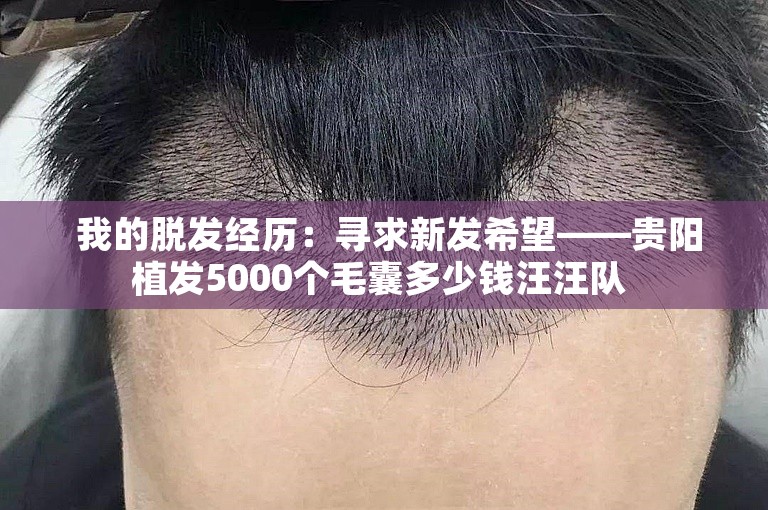  我的脱发经历：寻求新发希望——贵阳植发5000个毛囊多少钱汪汪队 