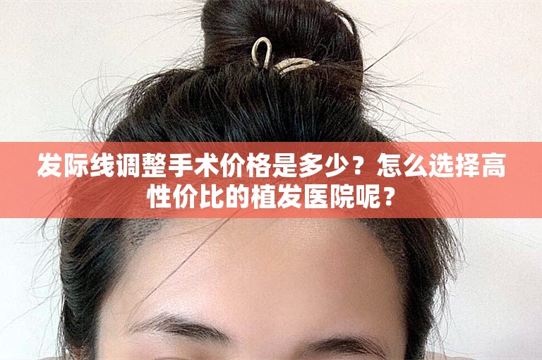 发际线调整手术价格是多少？怎么选择高性价比的植发医院呢？