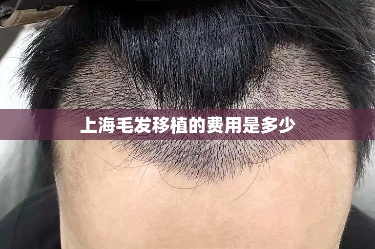 上海毛发移植的费用是多少