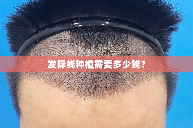 发际线种植需要多少钱？