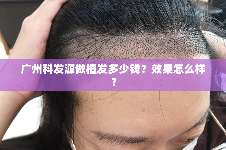 广州科发源做植发多少钱？效果怎么样？