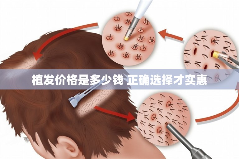 植发价格是多少钱 正确选择才实惠