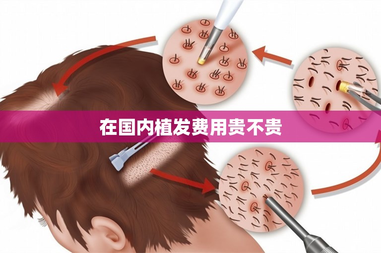 在国内植发费用贵不贵