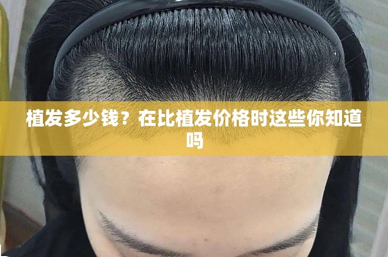 植发多少钱？在比植发价格时这些你知道吗