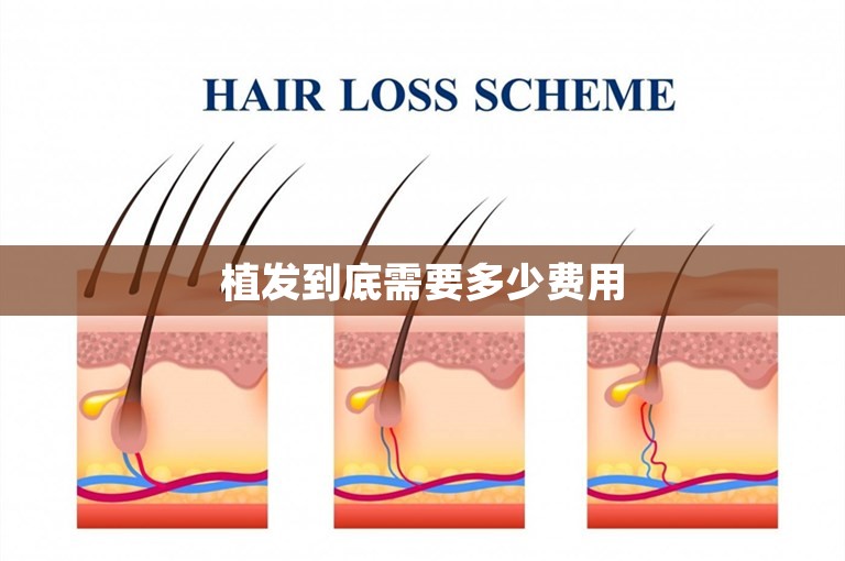 植发到底需要多少费用
