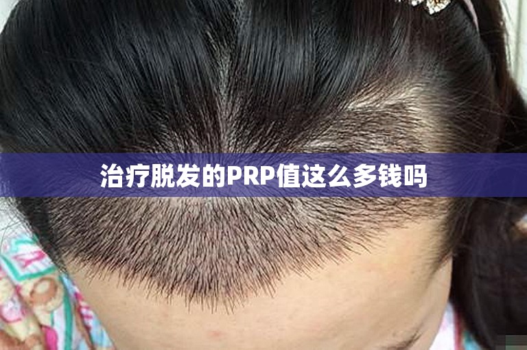 治疗脱发的PRP值这么多钱吗