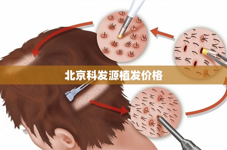 北京科发源植发价格