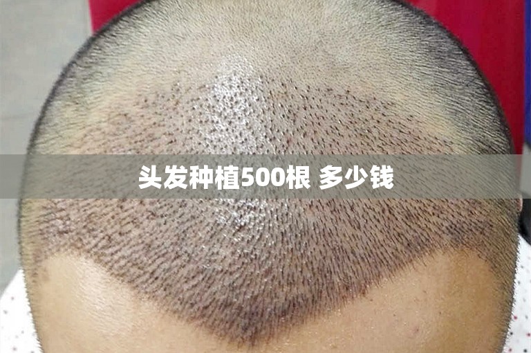 头发种植500根 多少钱