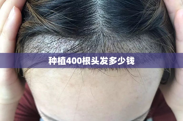 种植400根头发多少钱