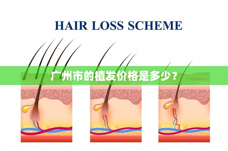 广州市的植发价格是多少？