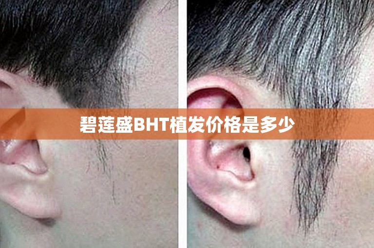 碧莲盛BHT植发价格是多少