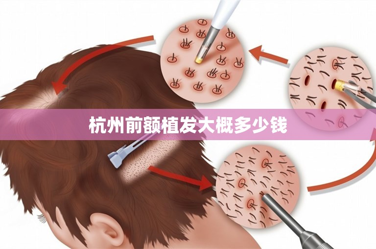 杭州前额植发大概多少钱