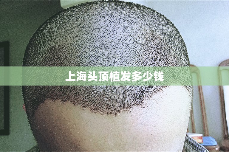 上海头顶植发多少钱