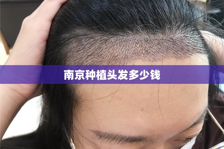 南京种植头发多少钱