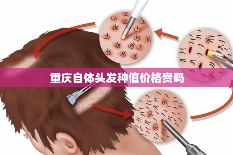 重庆自体头发种值价格贵吗