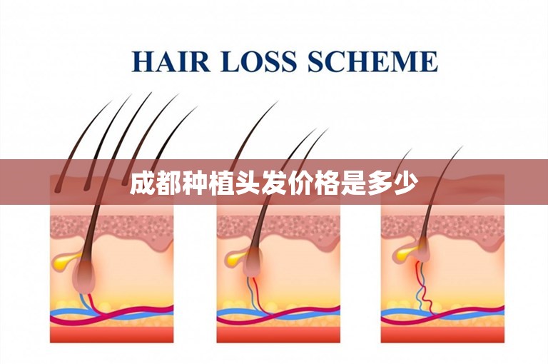 成都种植头发价格是多少