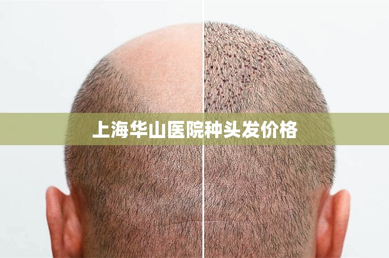 上海华山医院种头发价格
