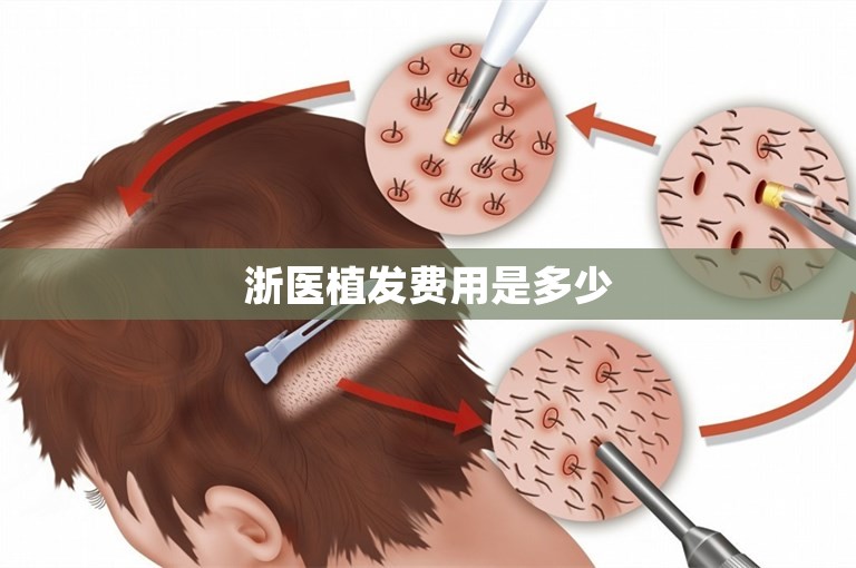 浙医植发费用是多少