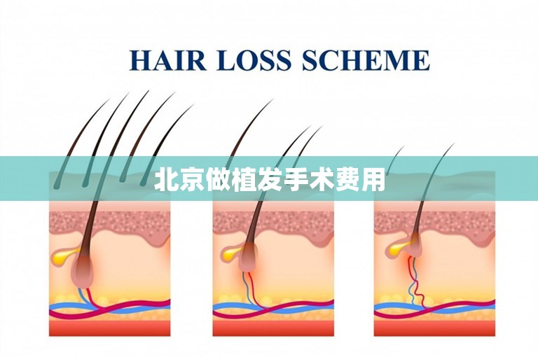 北京做植发手术费用