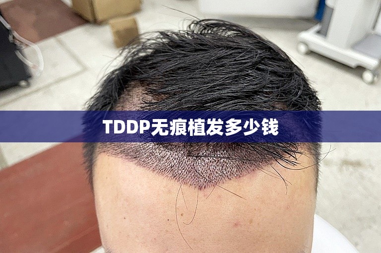 TDDP无痕植发多少钱
