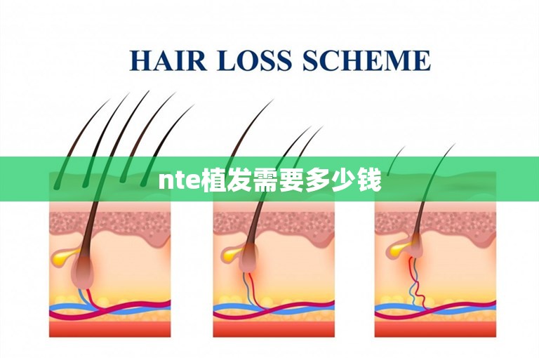 nte植发需要多少钱