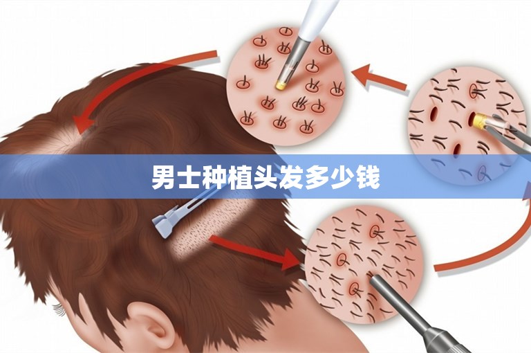 男士种植头发多少钱