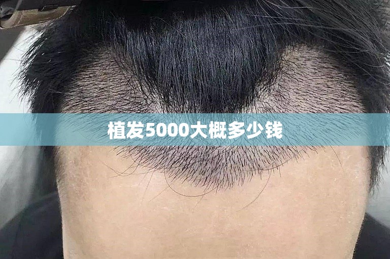 植发5000大概多少钱