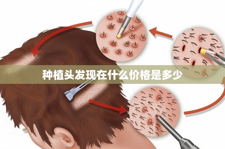 种植头发现在什么价格是多少